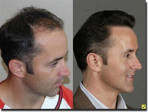 Dr. Ron Shapiro Hair transplant surgery before and after photos