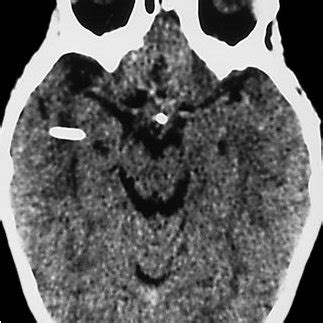 Axial CT scan demonstrating large enhancing cystic craniopharyngioma... | Download Scientific ...