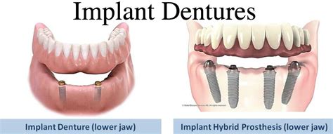 Types of Implant Dentures