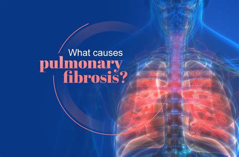 Pulmonary Fibrosis What Is It Causes Symptoms Risk And Treatment | The ...