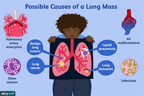 Possible Causes of a Lung Mass
