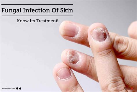 Fungal Infection Of Skin - Know Its Treatment! - By Dr. Malini Patil ...