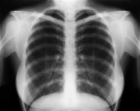 COPD Chest X-Ray | COPD Lung X Ray | X-Ray | Pinterest | Lungs