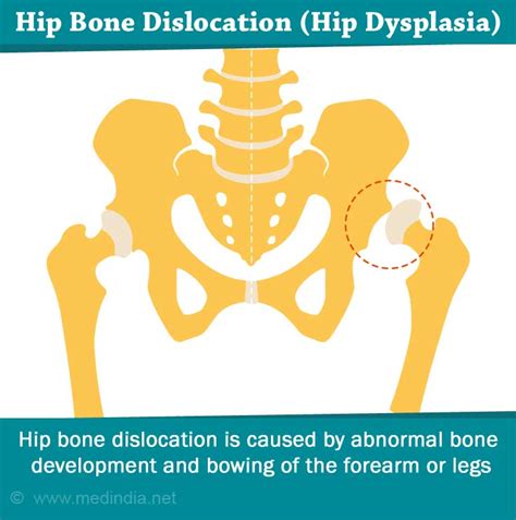 Exostoses / Multiple Non-cancerous Bone Tumors - Causes, Symptoms, Diagnosis and Treatment