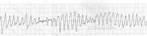 ECG Basics: Torsades de Pointes | ECG Guru - Instructor Resources