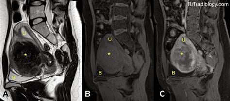 RiT radiology: Uterine Leiomyoma on MRI