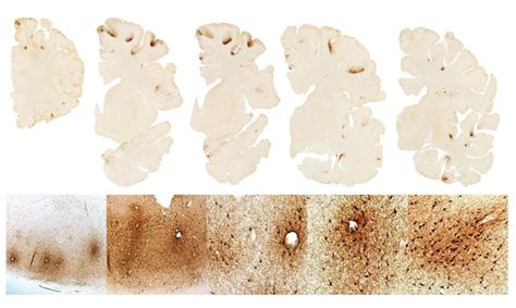 Learn the symptoms in the four stages of CTE - The Boston Globe