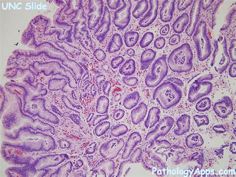 reactive gastropathy stomach histology