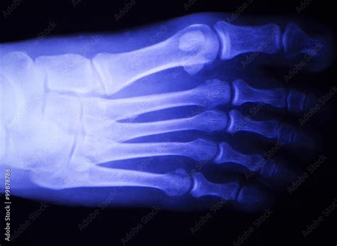 Foot and toes injury x-ray scan Stock Illustration | Adobe Stock