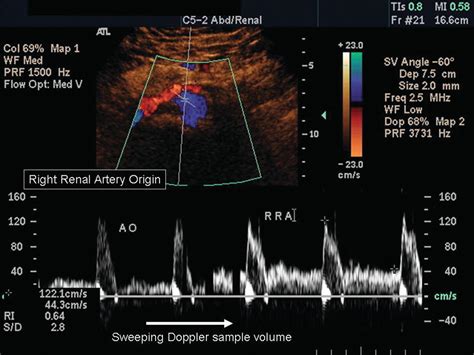 Renal Duplex Scanning | Thoracic Key