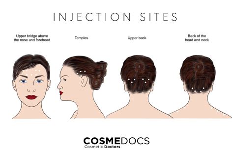 Botox Injection Sites For Migraines Diagram