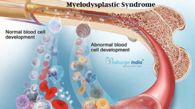 Myelodysplastic Syndrome Treatment In India | MDS Treatment In India