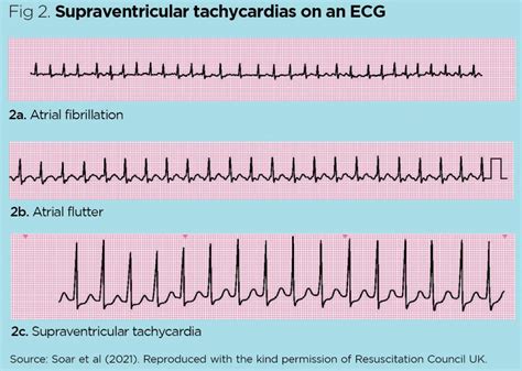 Supraventricular Tachycardia Rhythm Strip