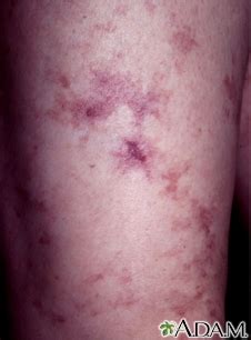 Livedo Reticularis Symptoms, Doctors, Treatments, Advances & More | MediFind