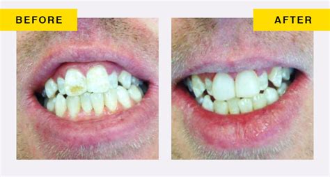 Enamel hypoplasia corrected with tooth bonding - Smile Dental - Dr. Jyothi Dravid - Auckland ...