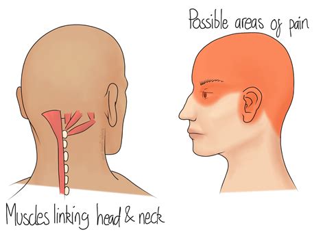 Cervicogenic Headaches - Ilminster Osteopathy