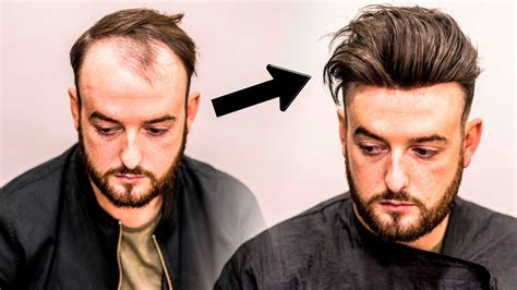 Mens Hair Loss Treatment | Hairstyle Transformation - Does it Work? - YouTube