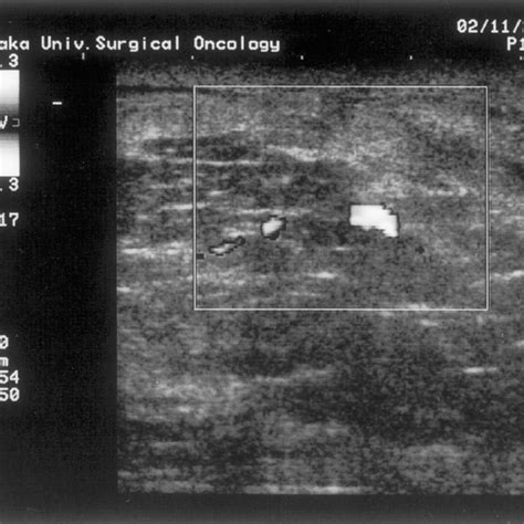 Buried DIEP flap for reconstruction of the breast after skin-sparing... | Download Scientific ...