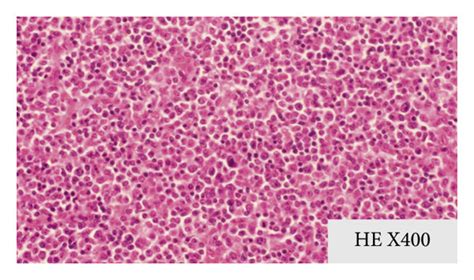 Histopathological examination of a cervical lymph node biopsy showing ...