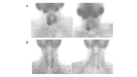 Dual phase 99mTc MIBI scan at 20 min (early phase) on the left and at 2 ...