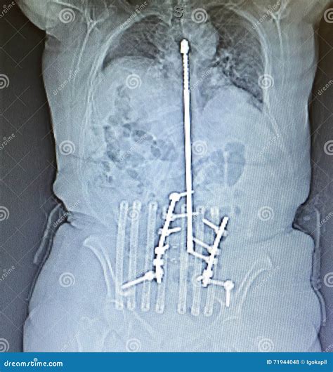 Xray Posterior Harrington Rod Spinal Vertebrae Pathology Stock ...