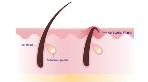 Keratosis Pilaris: Causes, symptoms and treatment - HealthKart