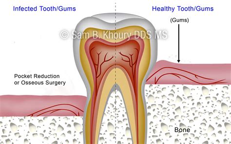 Gum Disease Surgical Procedures | Pocket Reduction Surgery