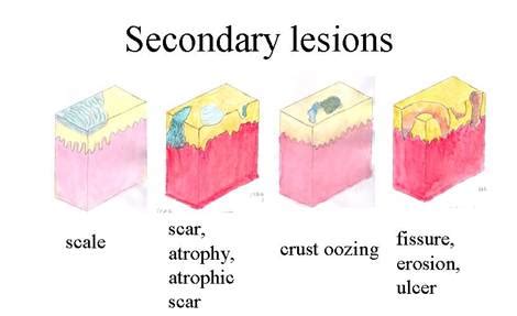 Secondary lesions