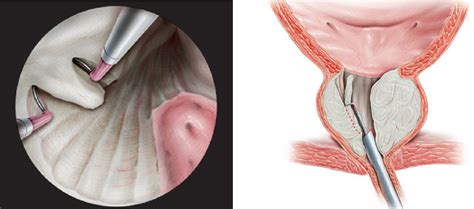 Urology Notes 2012: How to perform TURP? (post) step-by-step operative urology series