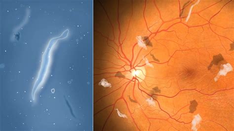 Eye Floaters & Black Spots in Vision | Retina Doctor Melbourne