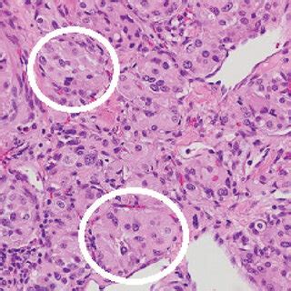 Cardiac paraganglioma histology. Chromaffin cells positive with ...