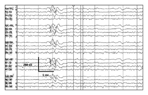 Ictal EEG recording of epileptic spasms in a two-year-old girl with... | Download Scientific Diagram