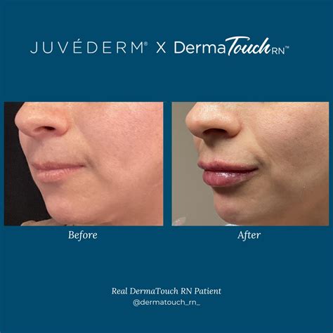 DermaTouch RN - Subtle volume was achieved with JUVEDERM...