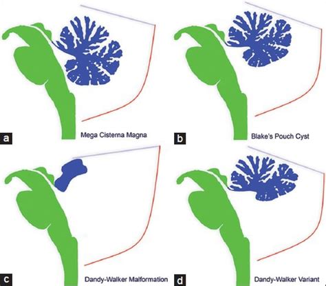 Diagrammatic representation of the cerebellar vermis in various ...