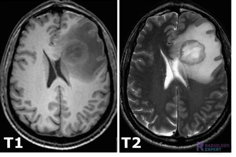 MRI Technique