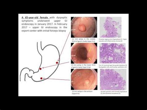 Diet Stomach Polyps - Health | NoahStrength.com