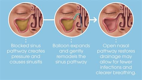 Balloon Sinuplasty — julianhamann.com