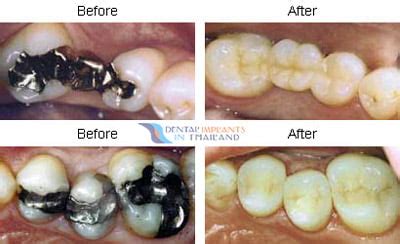 Quality Dental Inlays and Onlays | Price Comparison