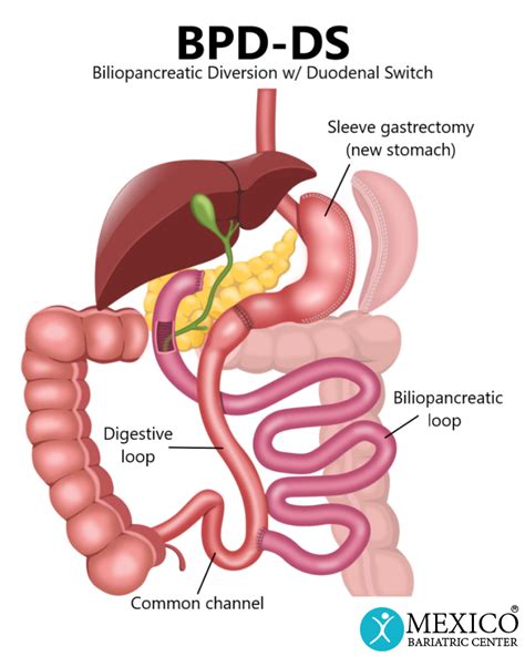 Single-Anastamosis Duodenal Switch - Mexico Bariatric Center