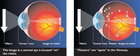 Spots Before Your Eyes | Rand Eye Institute