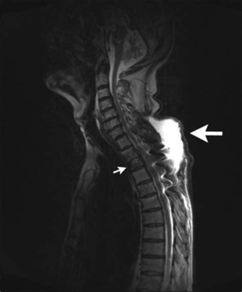 Pott's Disease - Physiopedia