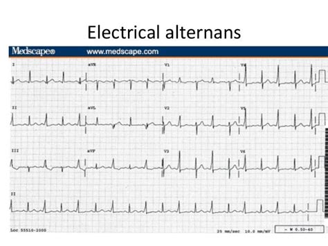 Electrical: Electrical Alternans