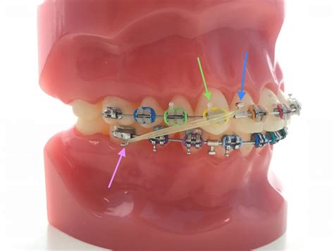 CLASS II ELASTICS | About Braces