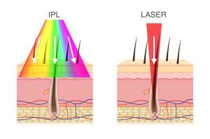 How Does IPL Laser Work? Uses, Benefits & Side Effects To Know In 2023