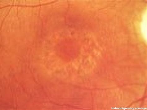 Plaquenil Maculopathy