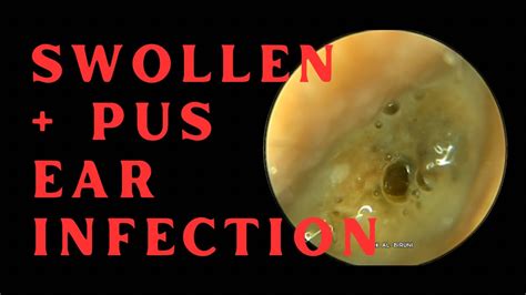 SWOLLEN & PUS FILLED EAR CANAL DUE TO INFECTION!!! (4K 60FPS) - YouTube