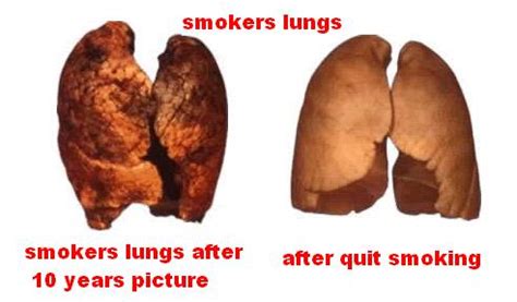 smokers lungs: smokers lungs after 10 years