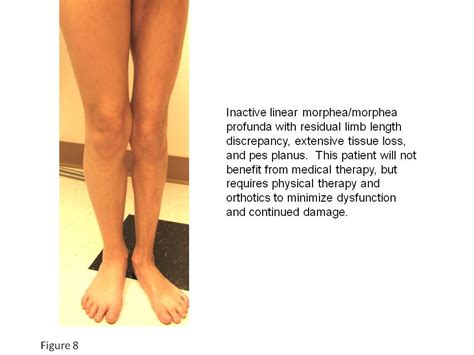 Morphea (Localized Scleroderma) - The Clinical Advisor