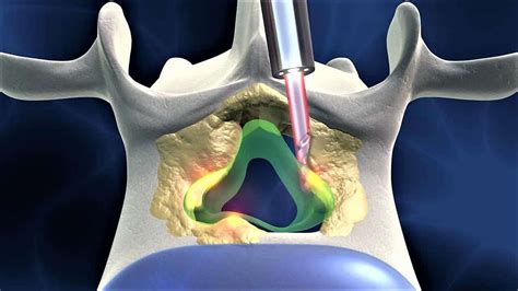 Ever-expanding role of endoscopy in spine diseases - Spinomax