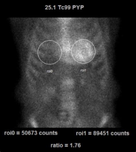 Cardiac Amyloidosis Scan - Hamilton Cardiology Associates - New Jersey ...